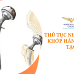 thu tuc nhap khau khop hang nhan tao