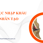 THỦ TỤC NHẬP KHẨU KHỚP NHÂN TẠO