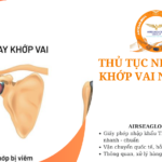 thu tuc nhap khau khop vai nhan tao