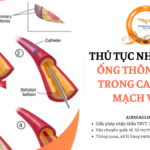 thu tuc nhap khau ong thong dung trong can thiep mach vanh