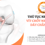 thu tuc nhap khau vit chot neo co dinh day chang cheo,
