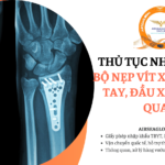 thu tuc nhap khau bo nep vit xuong ban tay dau xa xuong quay